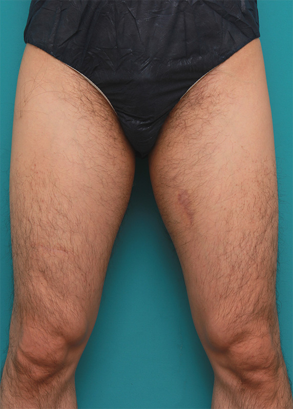 医療レーザー脱毛,男性の太もも、ビキニラインの無駄毛をレーザー永久脱毛（医療脱毛）した症例写真,Before,ba_epi10_b.jpg