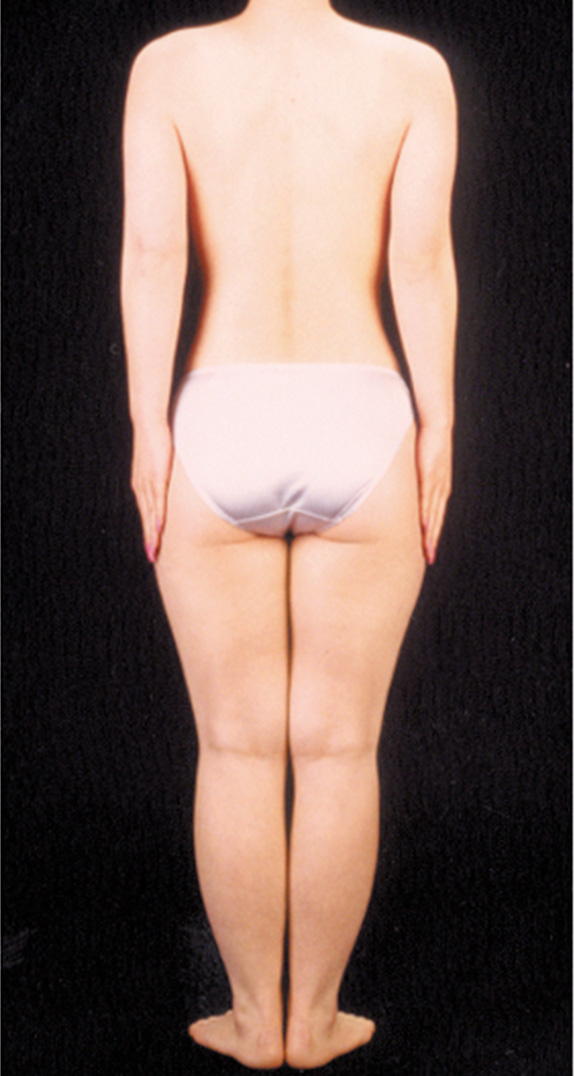 症例写真,脂肪吸引の症例写真　太ももの内側・外側,Before,ba_shibokyuin46_b.jpg