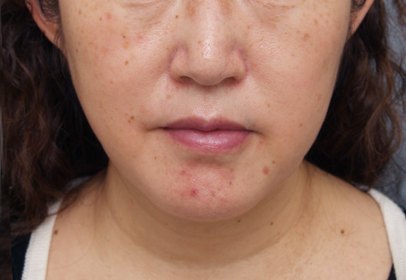 脂肪吸引（頬、あご）,脂肪吸引,40代女性のたるんでいる顔に、頬、顎下の脂肪吸引をした症例写真,After,ba_shibokyuin51_a01.jpg