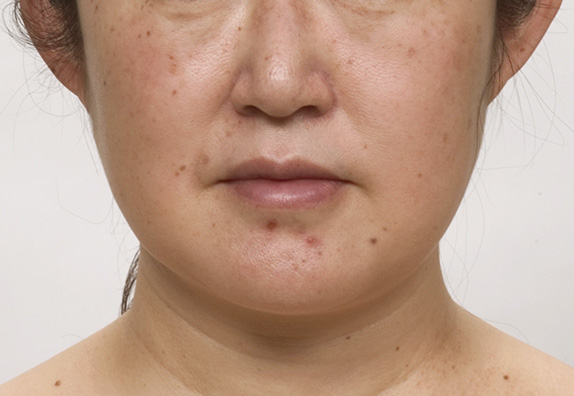 脂肪吸引（頬、あご）,40代女性のたるんでいる顔に、頬、顎下の脂肪吸引をした症例写真,Before,ba_shibokyuin51_b.jpg