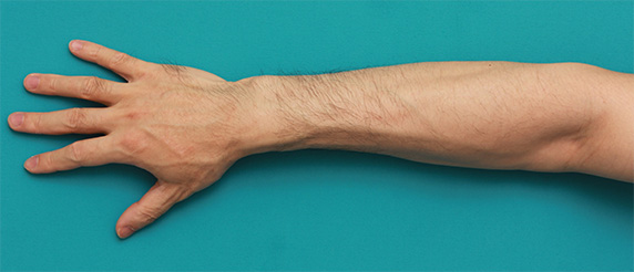 医療レーザー脱毛,男性の手の甲、手の指、前腕のムダ毛をレーザー医療脱毛で永久脱毛した症例写真,Before,ba_epi12_b.jpg