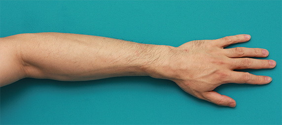 医療レーザー脱毛,男性の手の甲、手の指、前腕のムダ毛をレーザー医療脱毛で永久脱毛した症例写真,Before,ba_epi13_b.jpg