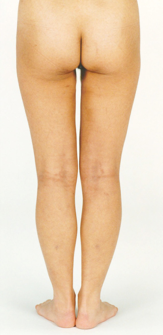脂肪吸引,脂肪吸引の症例写真　大腿,After,ba_shibokyuin33_b.jpg