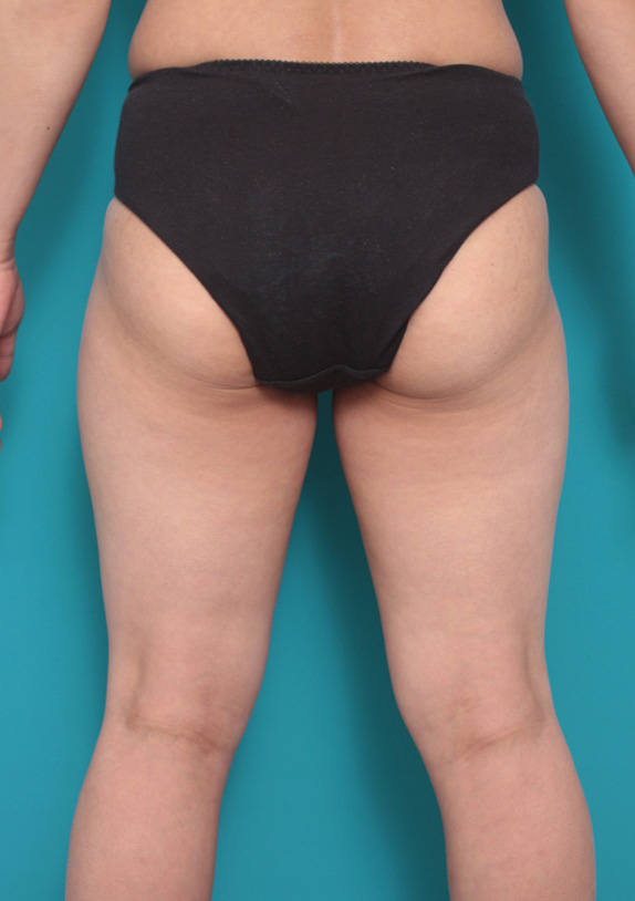 脂肪吸引,ウエスト、お尻、太もも全体の脂肪吸引の症例写真,Before,ba_shibokyuin61_b.jpg