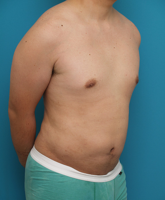 脂肪吸引,脂肪吸引の症例 お腹がでっぱり背中も脂肪が段になっていた40代男性,After,ba_shibokyuin44_b.jpg