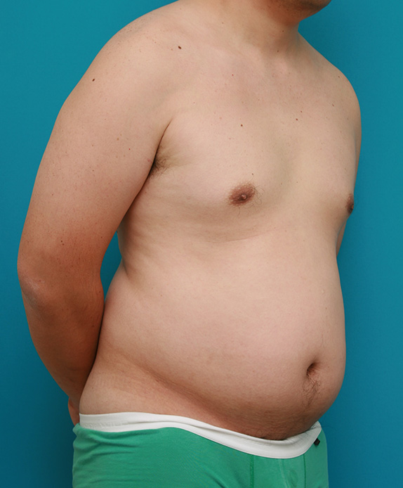 脂肪吸引,脂肪吸引の症例 お腹がでっぱり背中も脂肪が段になっていた40代男性,Before,ba_shibokyuin44_b.jpg