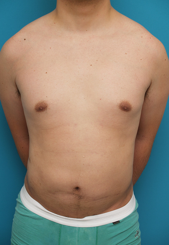 脂肪吸引,脂肪吸引の症例 お腹がでっぱり背中も脂肪が段になっていた40代男性,After,ba_shibokyuin52_b.jpg