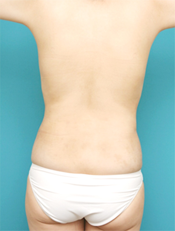 脂肪吸引,背中、ウエストの脂肪吸引症例写真,After,ba_shibokyuin58_b.jpg
