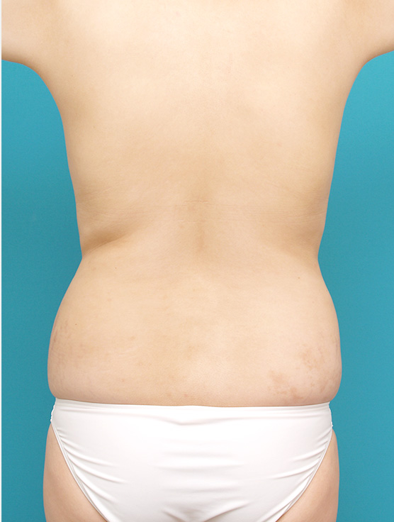 脂肪吸引,背中、ウエストの脂肪吸引症例写真,Before,ba_shibokyuin58_b.jpg