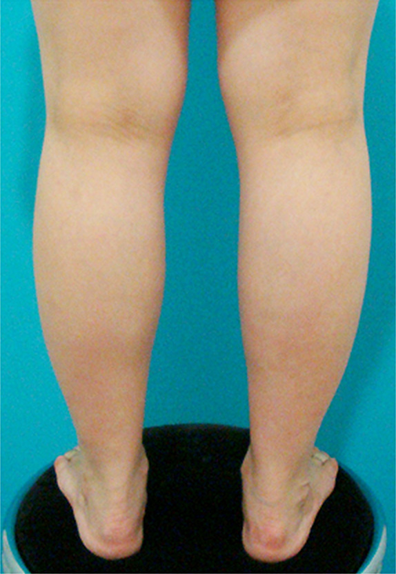 ボツリヌストキシン注射（ふくらはぎ・足やせ・美脚）,ボツリヌストキシン注射（ふくらはぎ・足やせ・美脚）症例写真 筋肉太りタイプ,Before,ba_leg_01_b.jpg