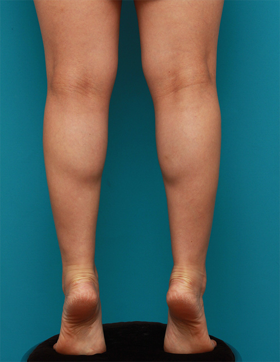 ボツリヌストキシン注射（ふくらはぎ・足やせ・美脚）症例写真,After（1ヶ月後）,ba_leg_02_a01.jpg
