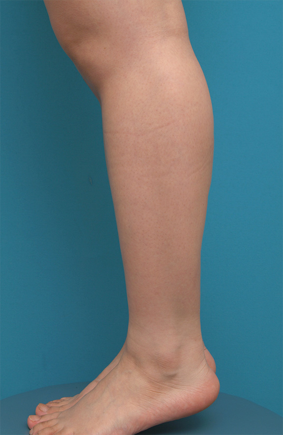 ボツリヌストキシン注射（ふくらはぎ・足やせ・美脚）,ボツリヌストキシン注射（ふくらはぎ・足やせ・美脚）の正面・側面・後面症例写真,After（2ヶ月後）,ba_leg_03b_b.jpg