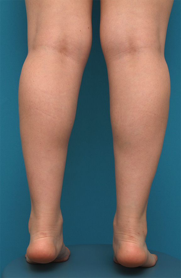 ボツリヌストキシン注射（ふくらはぎ・足やせ・美脚）,ボツリヌストキシン注射（ふくらはぎ・足やせ・美脚）の正面・側面・後面症例写真,After（2ヶ月後）,ba_leg_03c_b.jpg