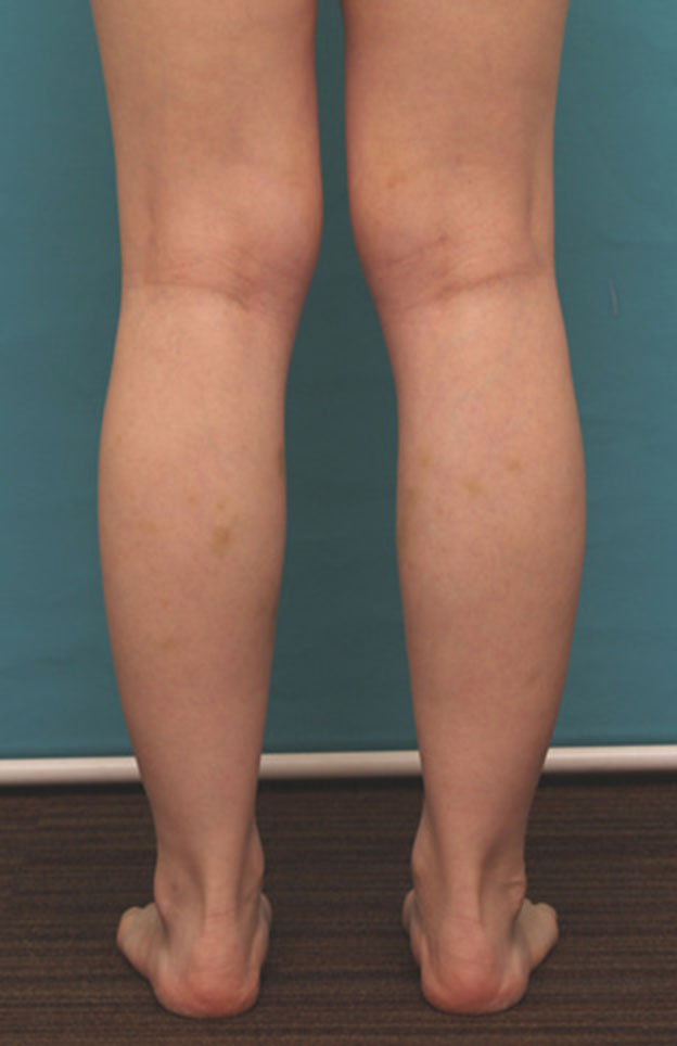 ボツリヌストキシン注射（ふくらはぎ・足やせ・美脚）,ボツリヌストキシン注射（ふくらはぎ・足やせ・美脚）で腓腹筋とヒラメ筋を萎縮させ、細い美脚にした症例写真の術前術後画像,注射直後,mainpic_leg02b.jpg