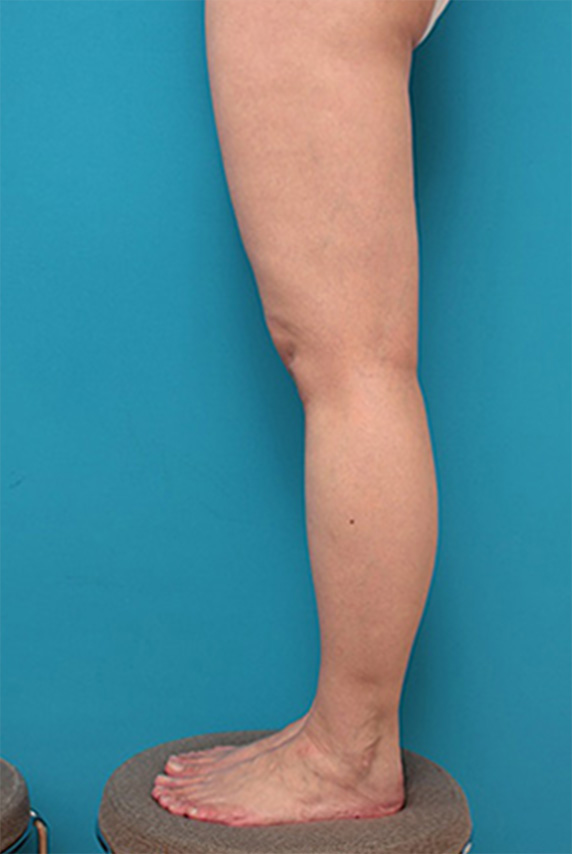 ボツリヌストキシン注射（ふくらはぎ・足やせ・美脚）,ボツリヌストキシン注射（ふくらはぎ・足やせ・美脚）の症例,After（6ヶ月後）,ba_leg17_b.jpg