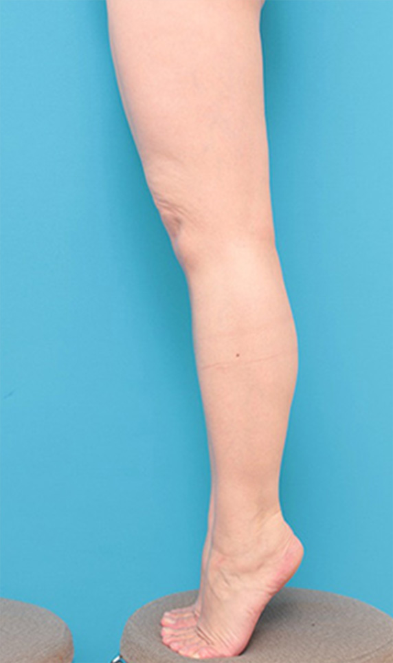 症例写真,ボツリヌストキシン注射（ふくらはぎ・足やせ・美脚）の症例,Before,ba_leg18_b.jpg