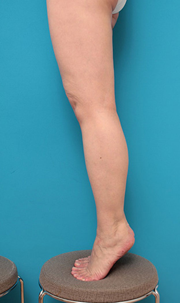症例写真,ボツリヌストキシン注射（ふくらはぎ・足やせ・美脚）の症例,6ヶ月後,mainpic_leg03l.jpg