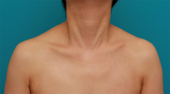 ボツリヌストキシン注射（美人肩）でゴツい肩をすっきりさせ、肩凝りも改善した症例写真の術前術後画像,Before,ba_shoulder_botox03_b.jpg