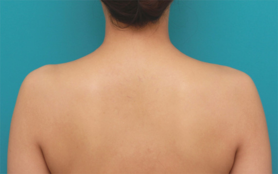 症例写真,ボツリヌストキシン注射（美人肩）でゴツい肩をすっきりさせ、肩凝りも改善した症例写真の術前術後画像,After（1ヶ月後）,ba_shoulder_botox04_b.jpg