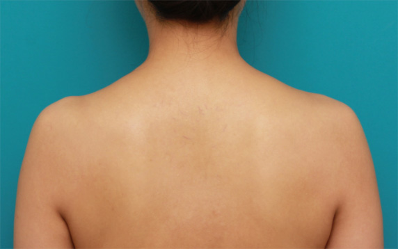 ボツリヌストキシン注射（美人肩）,ボツリヌストキシン注射（美人肩）でゴツい肩をすっきりさせ、肩凝りも改善した症例写真の術前術後画像,Before,ba_shoulder_botox04_b.jpg