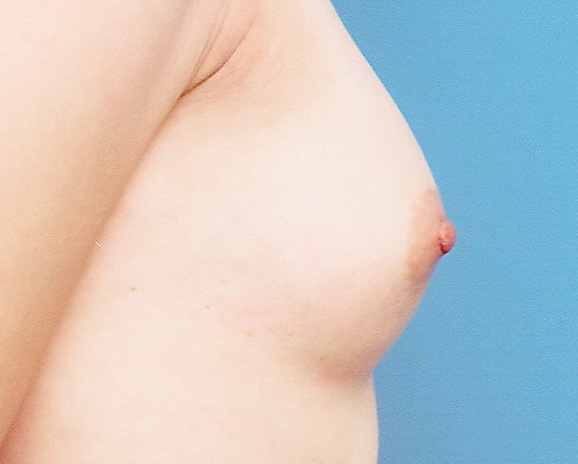 症例写真,乳頭縮小の症例 円柱状の大きな乳頭が目立つことが悩みの女性,After,ba_nyuto16_b.jpg