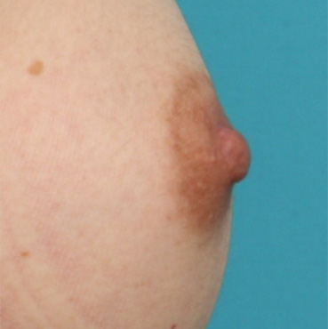 乳頭縮小,乳頭縮小の症例 横に平たく広がった乳首を気にしていた女性,After,ba_nyuto22_b.jpg
