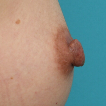 症例写真,乳頭縮小の症例 横に平たく広がった乳首を気にしていた女性,Before,ba_nyuto22_b.jpg