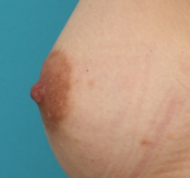 症例写真,乳頭縮小の症例 胸のバランスに比べ乳頭が大きいことを気にされていた女性,After,ba_nyuto21_b.jpg