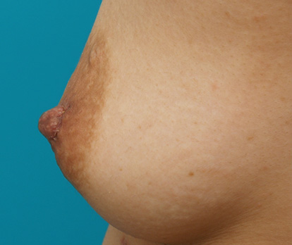 症例写真,乳頭縮小の症例 授乳が終わっても乳頭が元にもどらなかった女性,After（1週間後）,ba_nyuto13_b.jpg