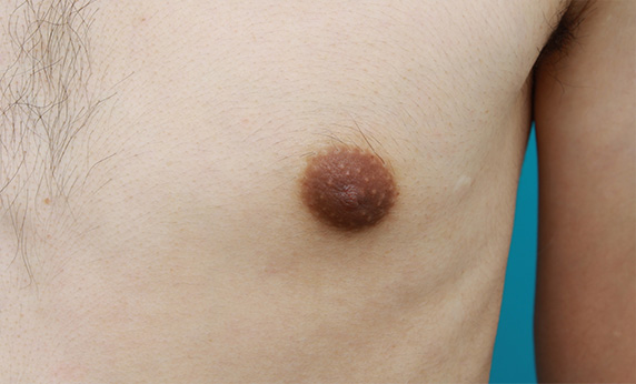 乳頭縮小,男性の乳頭縮小手術の症例写真,After（1ヶ月後）,ba_nyuto23_a01.jpg
