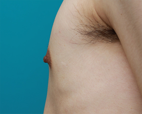乳頭縮小,男性の乳頭縮小手術の症例写真,Before,ba_nyuto24_b.jpg