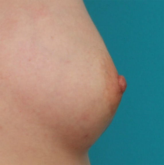 乳頭縮小,乳頭縮小の症例 バストの脂肪注入手術と同時に乳頭縮小も施術,After（4ヶ月後）,ba_nyuto26_b.jpg