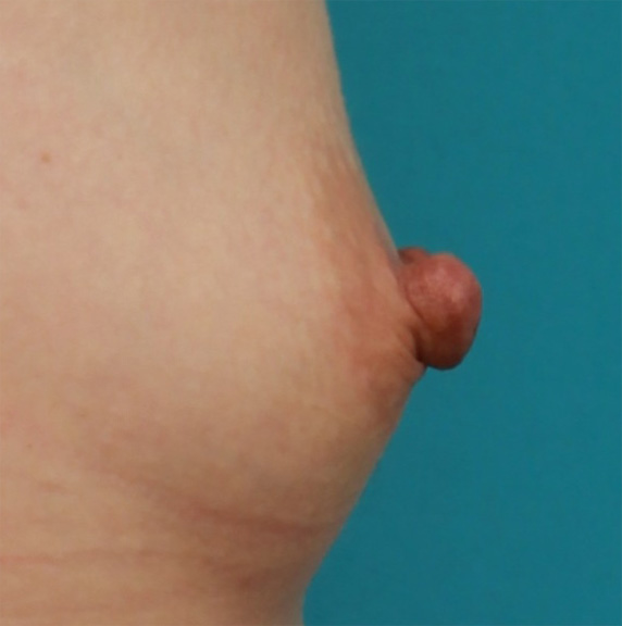 乳頭縮小,乳頭縮小の症例 バストの脂肪注入手術と同時に乳頭縮小も施術,Before,ba_nyuto26_b.jpg
