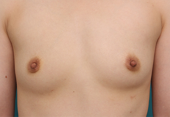 症例写真,乳頭縮小 妊娠、出産、授乳を繰り返し伸びてしまった乳首の症例,After（2週間後）,ba_nyuto27_b.jpg