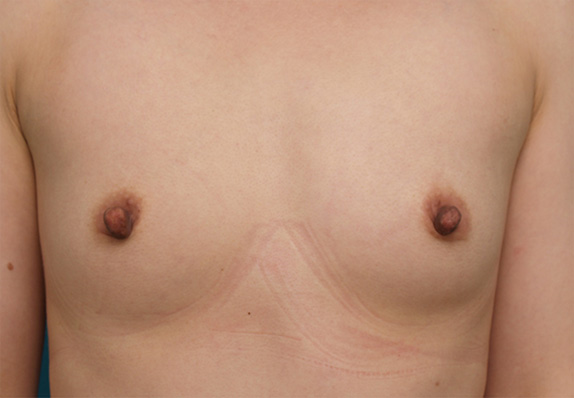 乳頭縮小,乳頭縮小 妊娠、出産、授乳を繰り返し伸びてしまった乳首の症例,Before,ba_nyuto27_b.jpg