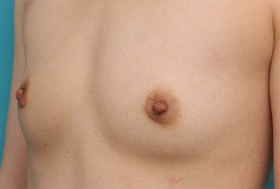 乳頭縮小,乳頭縮小 妊娠、出産、授乳を繰り返し伸びてしまった乳首の症例,After（2週間後）,ba_nyuto29_b.jpg