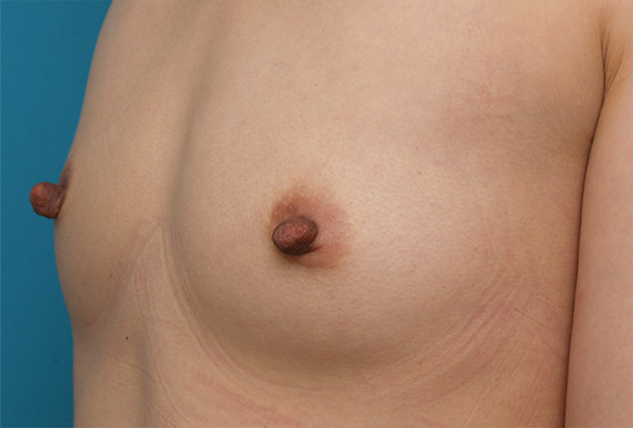 乳頭縮小,乳頭縮小 妊娠、出産、授乳を繰り返し伸びてしまった乳首の症例,Before,ba_nyuto29_b.jpg