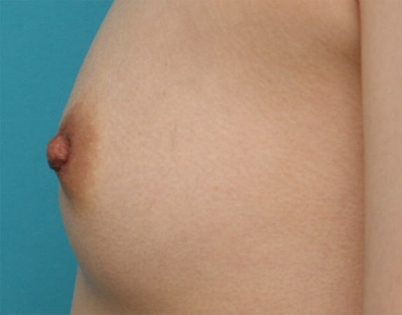 乳頭縮小,乳頭縮小 妊娠、出産、授乳を繰り返し伸びてしまった乳首の症例,After（2週間後）,ba_nyuto30_b.jpg