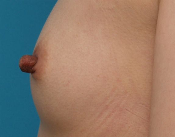 症例写真,乳頭縮小 妊娠、出産、授乳を繰り返し伸びてしまった乳首の症例,Before,ba_nyuto30_b.jpg