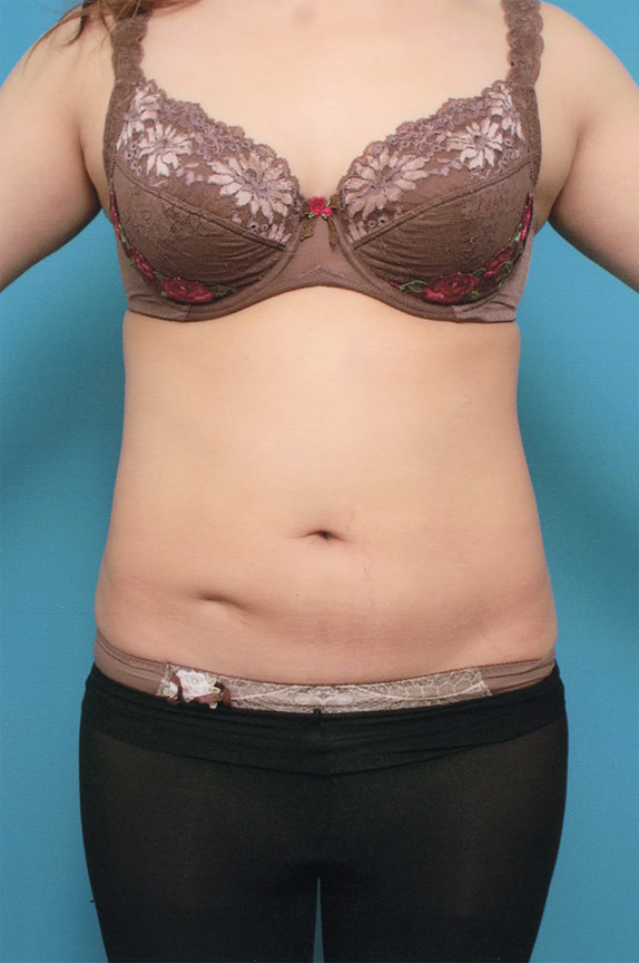 症例写真,イタリアン・メソシェイプ（イタリアンメソセラピー）・脂肪溶解注射の症例　上下腹部,Before,ba_meso52_b.jpg