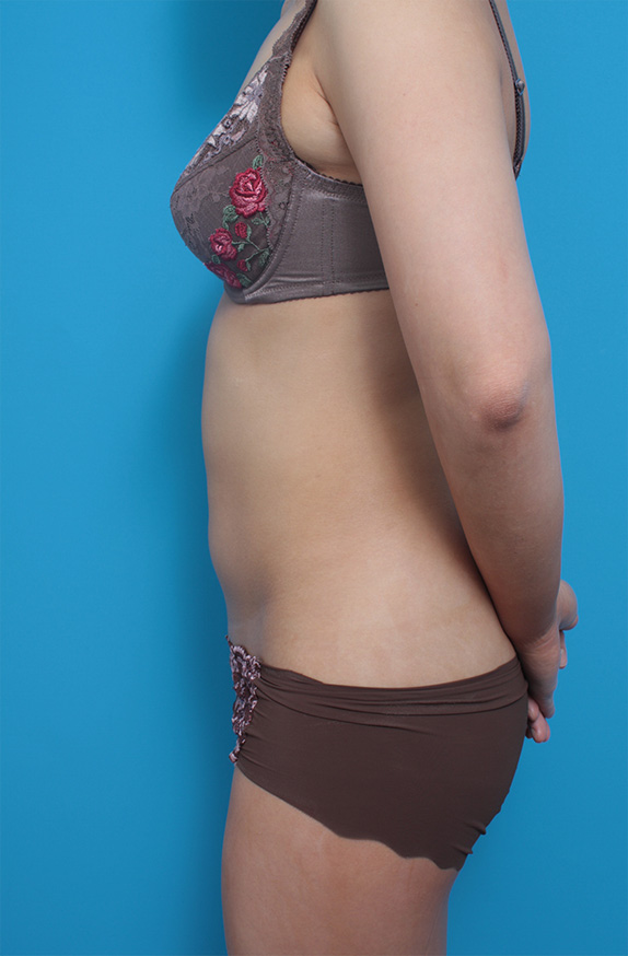症例写真,イタリアン・メソシェイプ（イタリアンメソセラピー）・脂肪溶解注射の症例　上下腹部,Before,ba_meso53_b.jpg