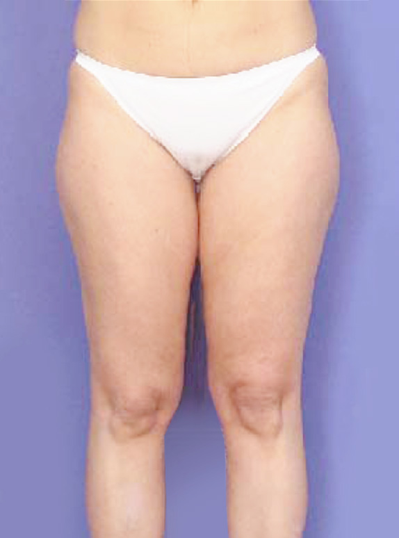症例写真,イタリアン・メソシェイプ（イタリアンメソセラピー）・脂肪溶解注射の症例 厚い脂肪の層がついたふとももに,After,ba_meso25_b.jpg