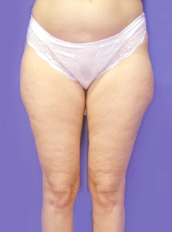 イタリアン・メソシェイプ（イタリアンメソセラピー）・脂肪溶解注射の症例 厚い脂肪の層がついたふとももに,Before,ba_meso25_b.jpg