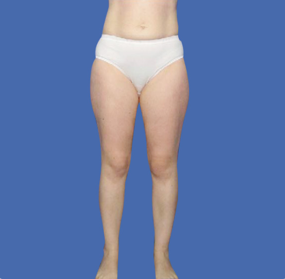 イタリアン・メソシェイプ（イタリアンメソセラピー）・脂肪溶解注射の症例 ふとももが他に比べ太いとお悩みの女性,After,ba_meso14_a01.jpg