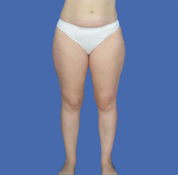 イタリアン・メソシェイプ（イタリアンメソセラピー）・脂肪溶解注射の症例 ふとももが他に比べ太いとお悩みの女性,Before,ba_meso14_b.jpg