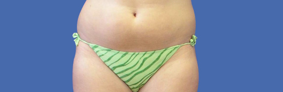 症例写真,イタリアン・メソシェイプ（イタリアンメソセラピー）・脂肪溶解注射の症例 おなかのぽっこりをどうにかしたい女性,Before,ba_meso16_b.jpg