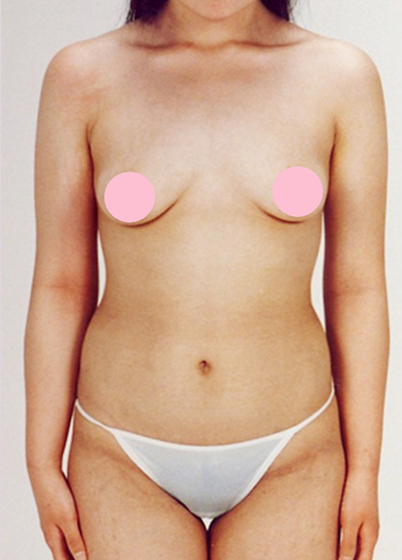 脂肪吸引,脂肪吸引の症例写真　腹部,After,ba_shibokyuin26_b.jpg