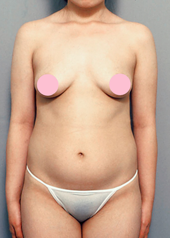 症例写真,脂肪吸引の症例写真　腹部,Before,ba_shibokyuin26_b.jpg