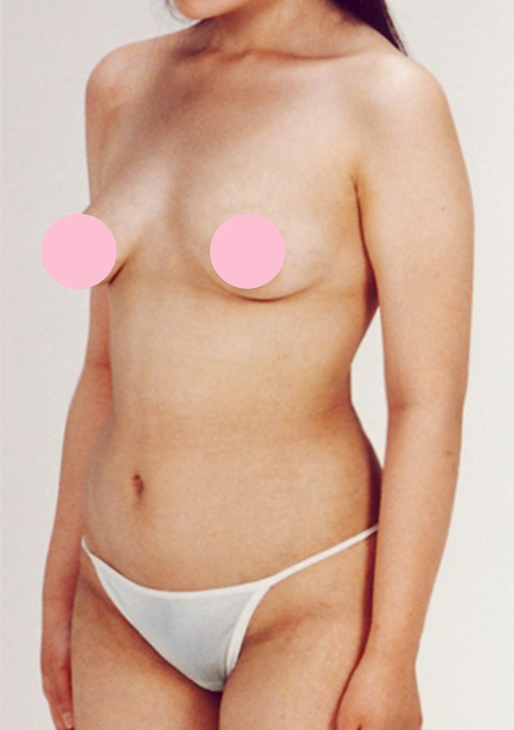 脂肪吸引,脂肪吸引の症例写真　腹部,After,ba_shibokyuin27_b.jpg