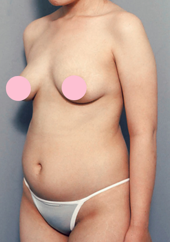 脂肪吸引,脂肪吸引の症例写真　腹部,Before,ba_shibokyuin27_b.jpg